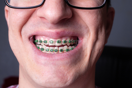 Braces and brackets on teeth, stamotology of medecine alignment of teeth orthodontist.の写真素材