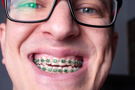 Braces and brackets on teeth, stamotology of medecine alignment of teeth orthodontist.の写真素材