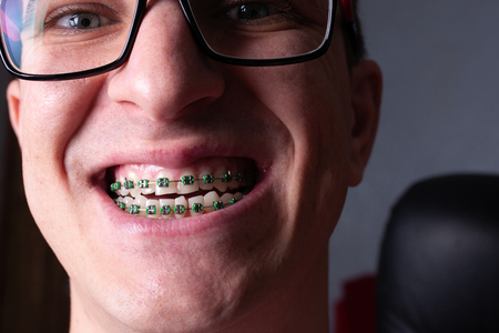 Face of a young man with metal dental braces and glasses close-up.の写真素材