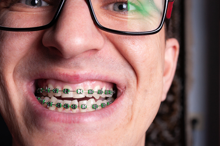 Portrait of a man with crooked teeth and metal braces with green rubber bands close-up. Young man with dental orthodontic braces.の写真素材