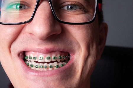 Portrait of a man with crooked teeth and metal braces with green rubber bands close-up. Young man with dental orthodontic braces.の写真素材