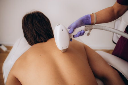 Hair removal cosmetology procedure from men back laser epilation studio.の写真素材