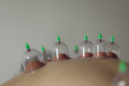 Cupping therapy. Closeup view of woman with glass cups on her back indoors