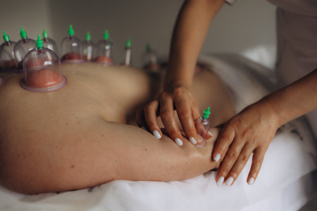 Vacuum cups of medical cupping therapy on woman back, close up, chinese medicine.の写真素材