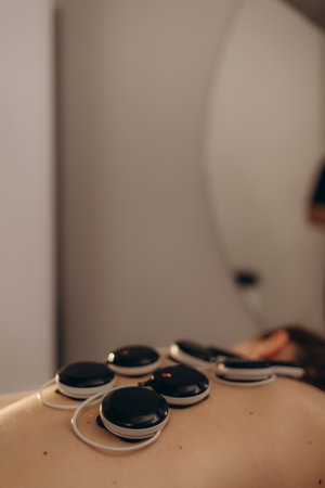 Electrotherapy pads placed on a person's back for muscle stimulation or physical therapy treatment. Showcasing a modern and effective approach to pain relief and rehabilitation in a healthcare environment.の写真素材