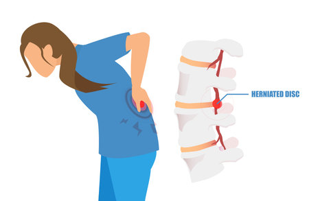 Vector of a young woman with a low back pain and sciatica from a herniated disc.のイラスト素材