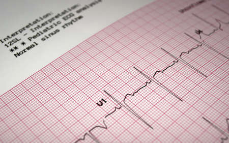 Heart analysis, ECG graph, pediatric electrocardiogram.の写真素材