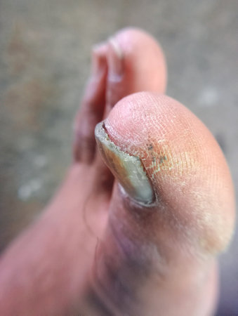 Foot of a man with a nail injury, close-up. Toes Nail bacterial treatment solutionの写真素材