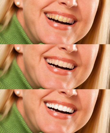 Smiling female showing progressive teeth whitening and bleaching.の写真素材