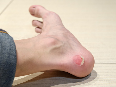 Big bloody callus on man's heel. Closeup foot of manの写真素材
