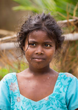 THIRUVANNAMALAI, INDIA - OCTOBER 10, 2013: This young girl is stricken by chicken pox, something her face and chest clearly show.のeditorial素材