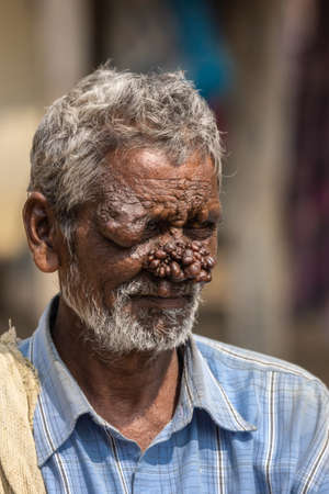 Belathur, Karnataka, India - November 1, 2013: Closeup of man with neurofibromatosis has face deformed with group of dark brown tumors on his nose. Blue shirt and gray hair.のeditorial素材