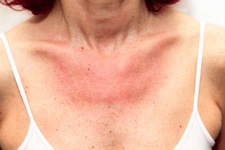 Woman with sunburns and Allergic reaction after unprotected sunbathing, acute state の写真素材