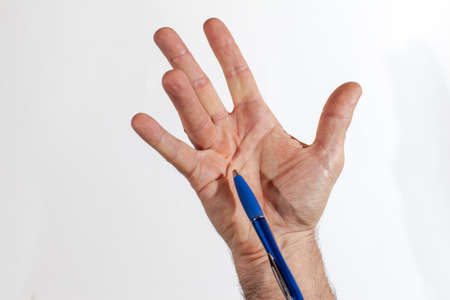 Hand of an man with Dupuytren contracture disease, pointing with pencil  on critical part, against  bright background, space for textの写真素材