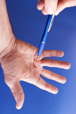 Hand of an man with Dupuytren contracture disease, pointing with pencil  on critical part, against medical blue background, space for textの写真素材