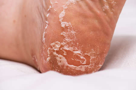 Skin peeling on the sole of a footの写真素材