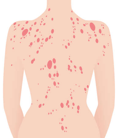 Human neck and back with psoriasis illustrationのイラスト素材