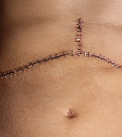 Closeup of medical staples helping a surgical incision and scar heal after an organ transplant operationの写真素材