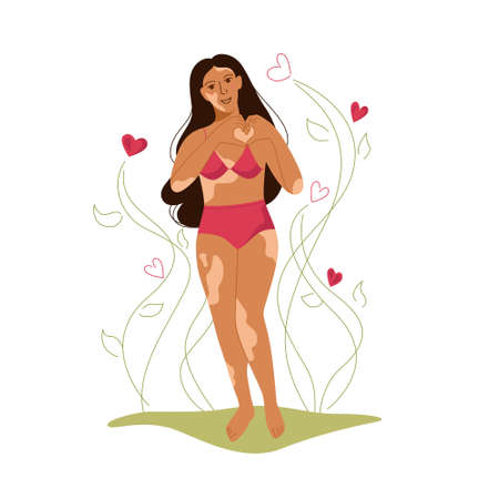 Cute girl with vitiligo. Body positive, self love, depigmentation disease, accepting Your Body. International Vitiligo Day. Modern vector illustration in flat styleのイラスト素材