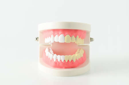Close up of white and yellow teeth model with red gum on white backgroundの写真素材