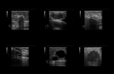 Ultrasonic study of the female breast to detect cancer tumorsの写真素材