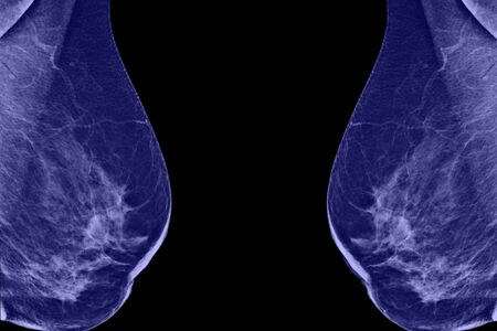 Lateral mammogram of female breast の写真素材