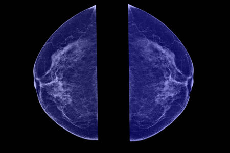 Lateral mammogram of female breast の写真素材