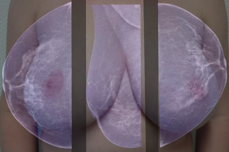 Lateral mammogram of female breast. In higher magnification you may see  small micro-calcifications as sign of probable malignancy of the tumor.の写真素材