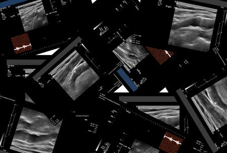 Ultrasound picture of carotid artery or arteria carotis externa