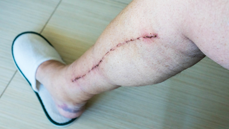 Selective focus of old male human leg with scar from cardiac surgery of coronary artery diseaseの写真素材