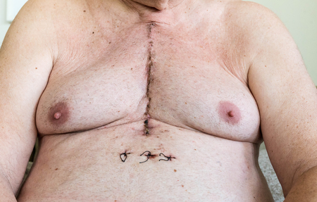 Scar from open heart surgery of coronary artery disease, where the sternum was cut in two, and the rib cage sprung. Below the scar holes show where the drains and pacemaker cables emerged. Image taken 12 days following surgeryの写真素材