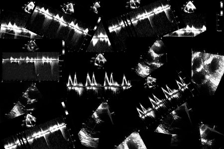 Cardiac ultrasound images . Screen of echo-cardiography machine. Doppler echo