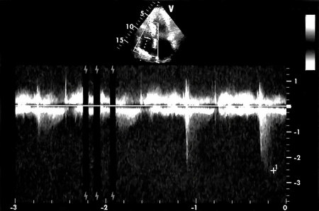 Cardiac ultrasound images . Screen of echo-cardiography machine. Doppler echo