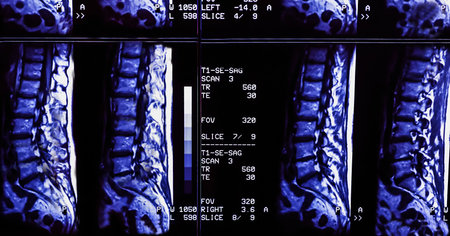 Results of magnetic resonance imaging of a patient spine with chronic back pain. The MRI shows...