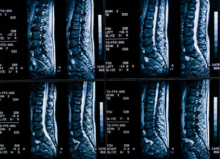 Magnetic resonance imaging of a patient spine with chronic back pain. The MRI shows degenerative...