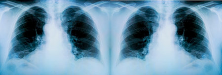 Set of X-ray of a patient's lungs with pronounced traces of the inflammatory process