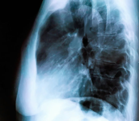 X-ray of a female patient's lungs with pronounced traces of the inflammatory process .