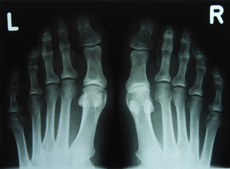 x-ray of feed and toeの写真素材