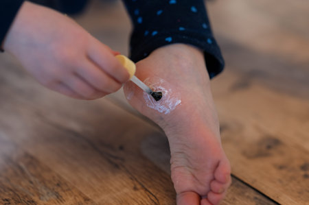 Treatment of warts on the sole of a six-year-old girl.