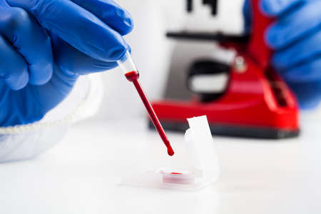 Lab scientist or medical technologist taking a blood sample using pipette dropper from a container,...