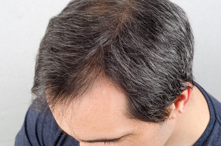 Mature man hair loss problem. health care shampoo and beauty product concep
