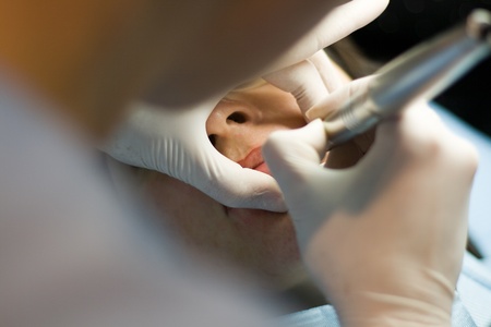 young female with a lips marked for plastic surgery 