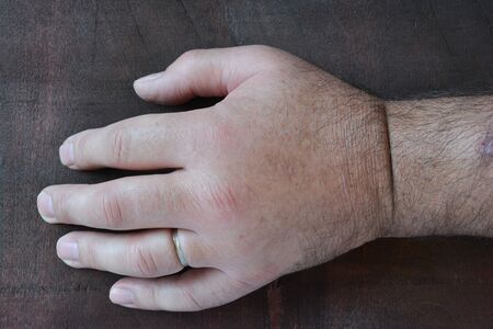 Swollen fist due to the sting of the wasp on dark wooden background, close up view