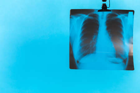 Lungs on a black and white photo taken on a photographic film of a special device.の写真素材