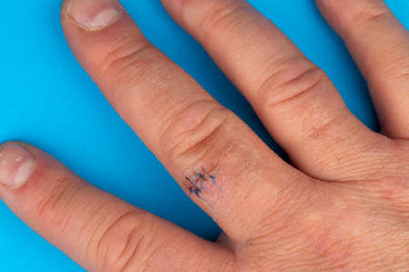 Postoperative sutures on the finger of the hand .. Stitches on the injured finger. Photo taken under...