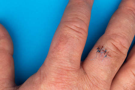 Postoperative sutures on the finger of the hand .. Stitches on the injured finger. Photo taken under...