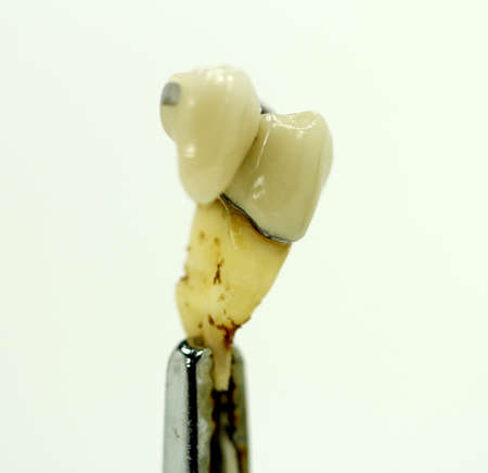 teeth bridge, dental crown