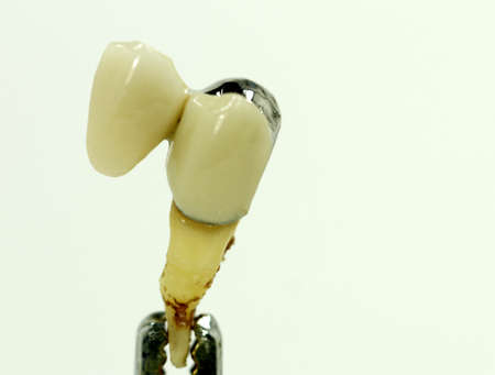 teeth bridge, dental crownの写真素材