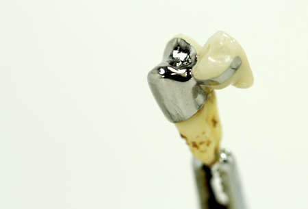 teeth bridge, dental crown