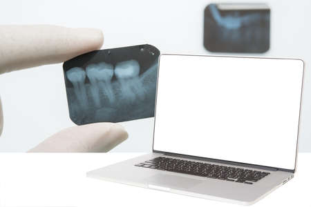 cmputer with white screen and hand hold a dental x-ray film in backgroundの写真素材